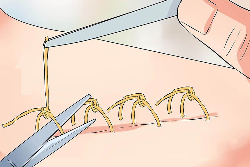 کشیدن بخیه در منزل کرج